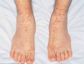 Inflamação nos vasos sanguíneos